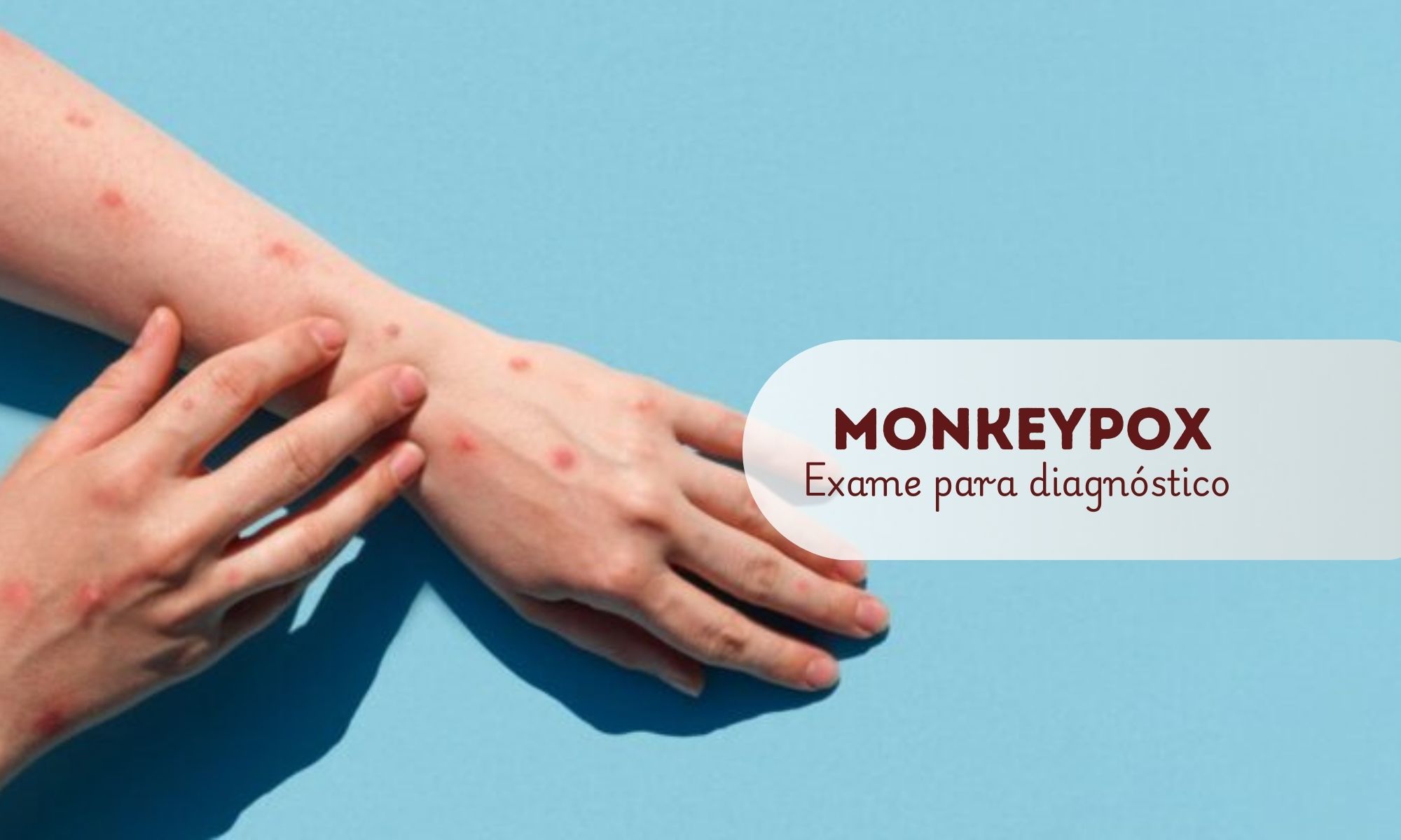 Exame para Diagnóstico de Varíola pelo Vírus Monkeypox
