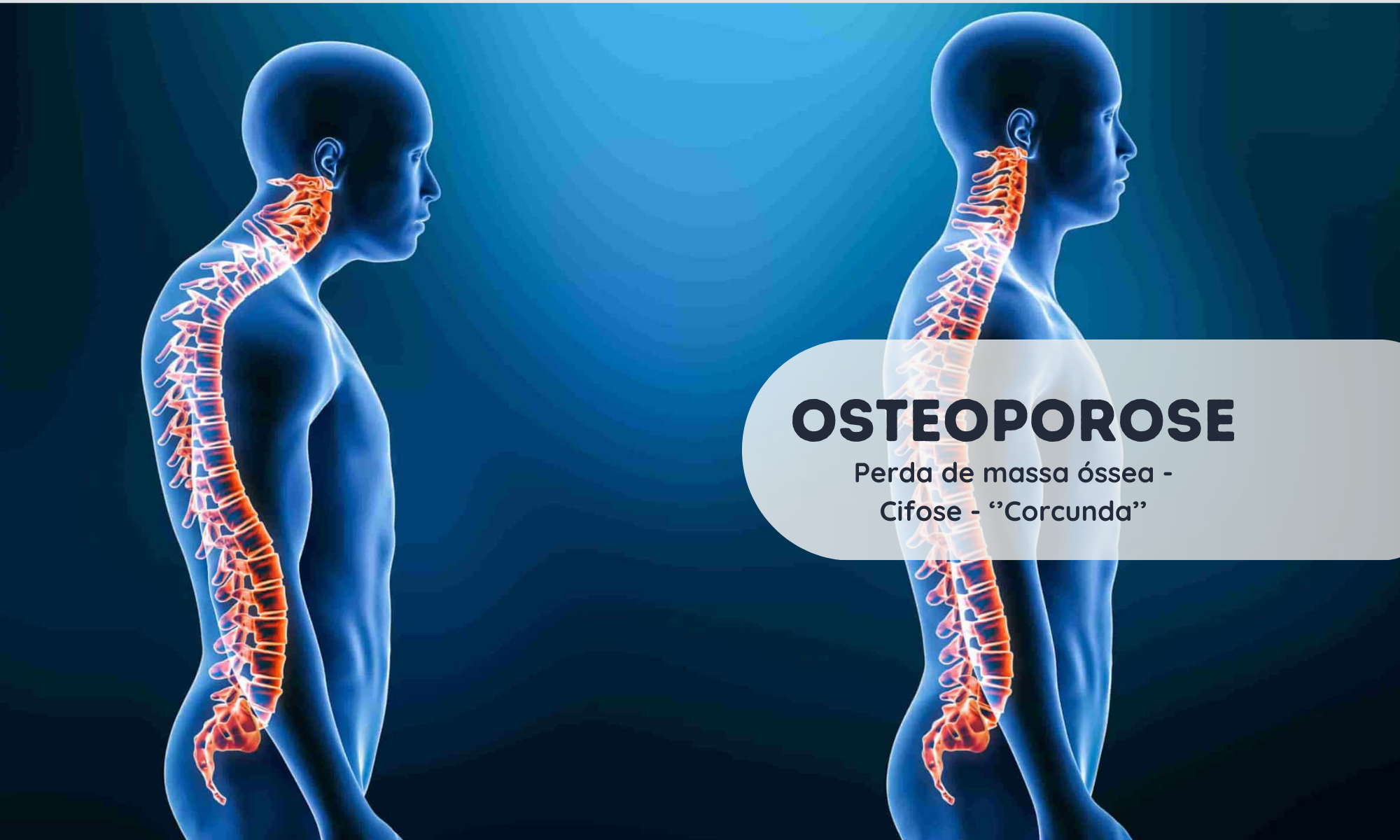 Osteoporose